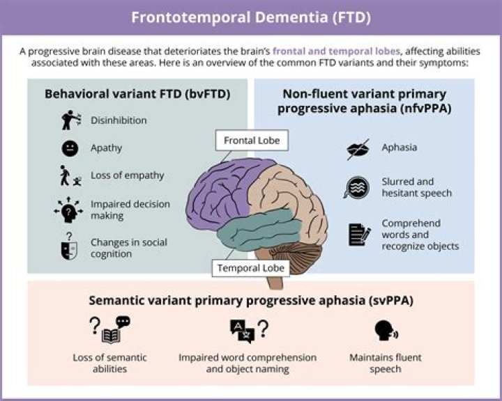 Frontotemporal Dementia (FTD) | Alzheimer's Society